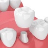 illustration of a dental crown