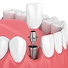 illustration of a dental implant