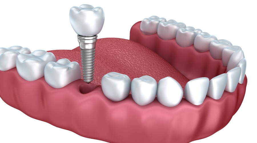 Computer image of a lower jaw of teeth with a dental implant to replace a missing tooth