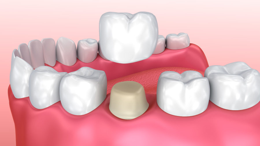 Drawing of a dental crown in Forest Hill, TX, being placed over a shaved down molar